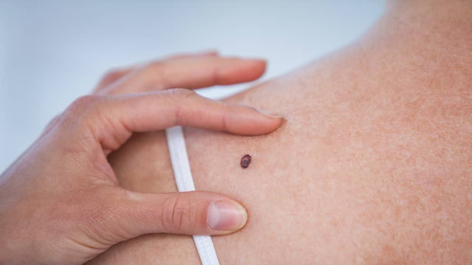 Why it would be a mistake to dismiss non-melanoma skin cancer