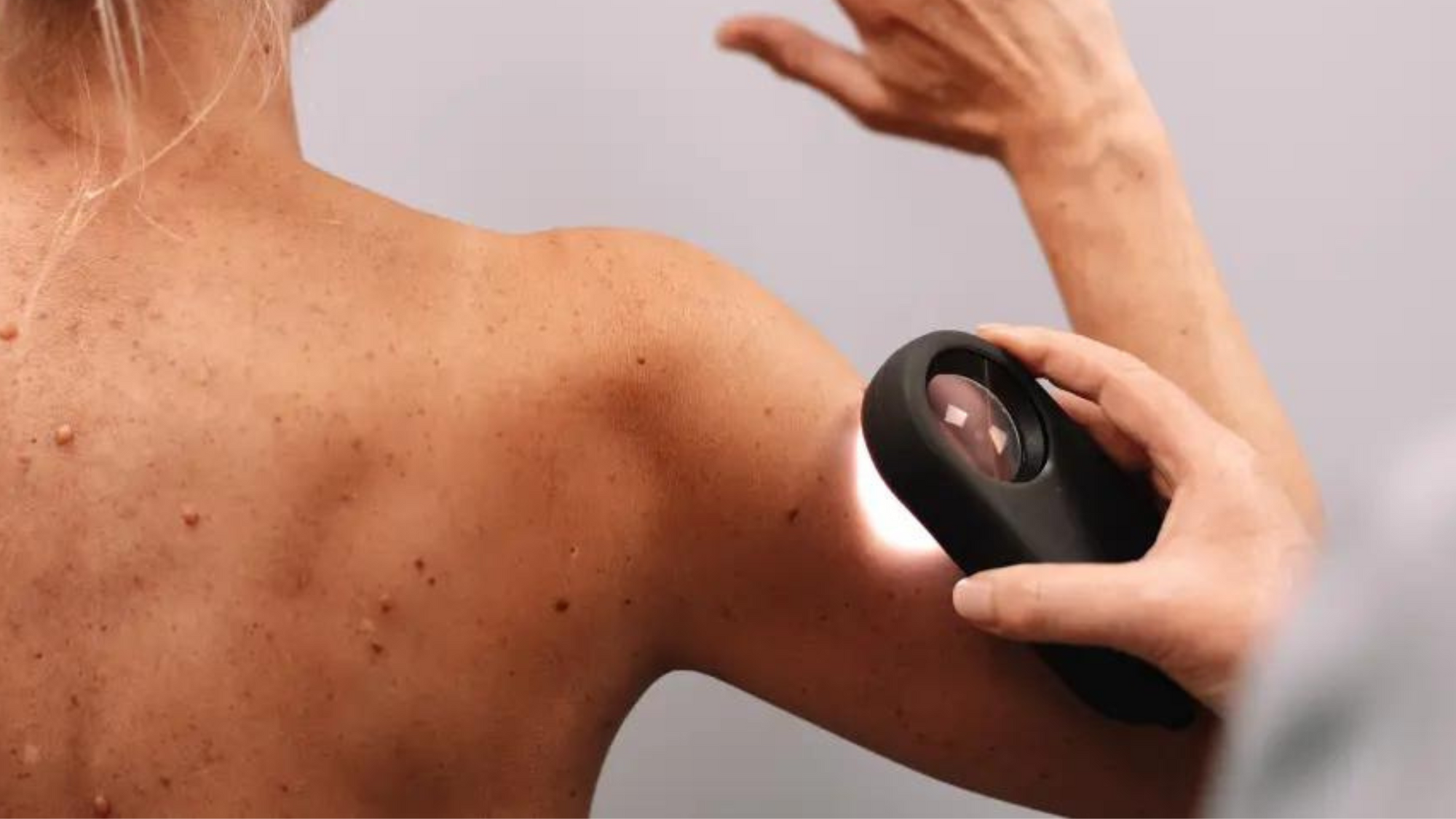 Checking your moles & why you should do it now