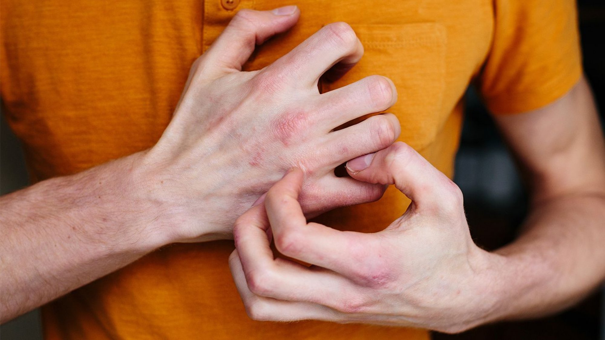 What is eczema?