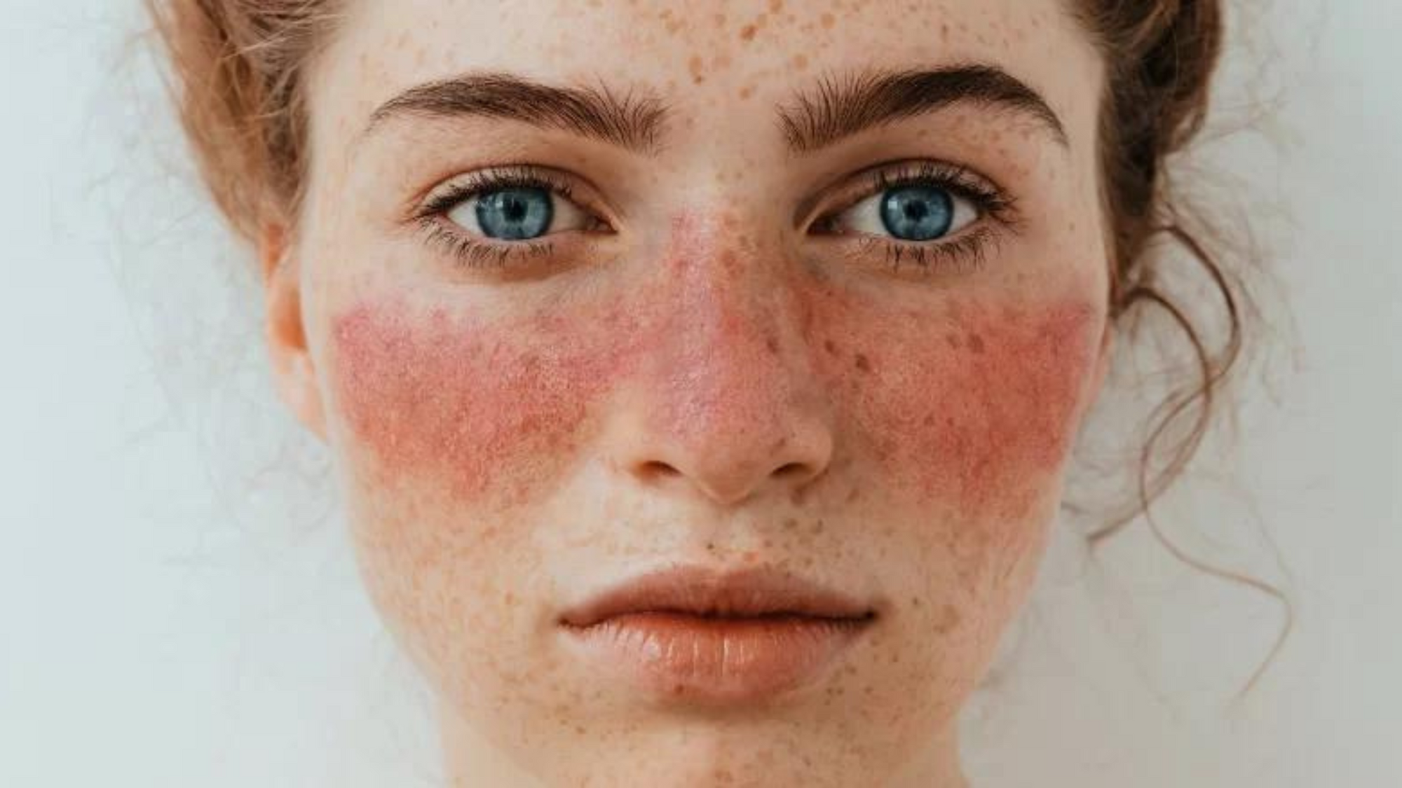 What is lupus?