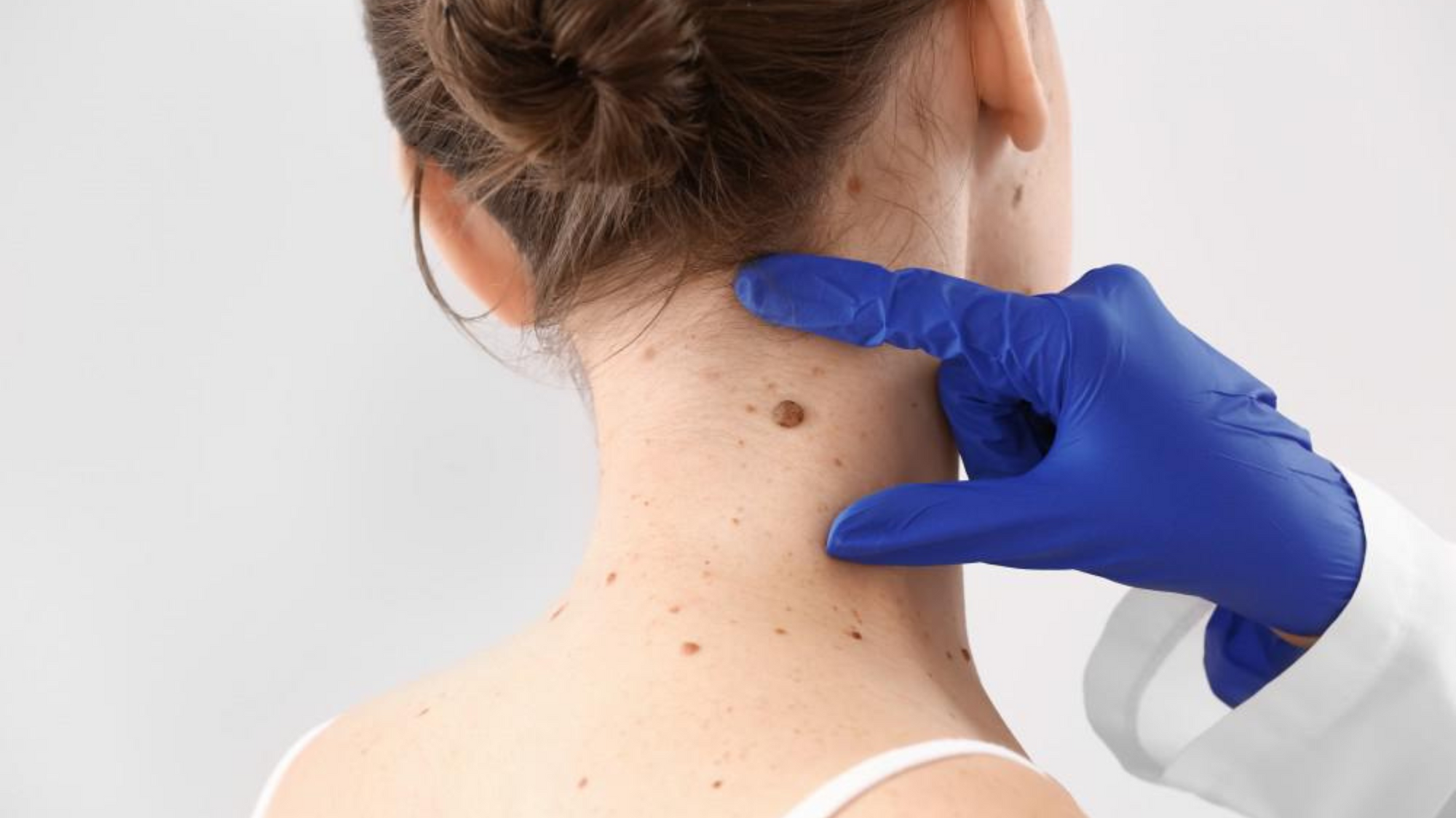 What to look out for: harmless mole or potential skin cancer?
