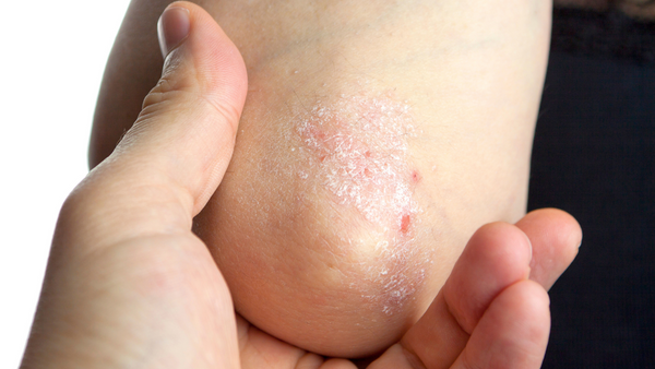 How can I stop psoriasis flare ups?