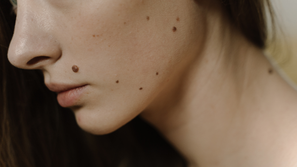 How do I know if a mole is cancerous?