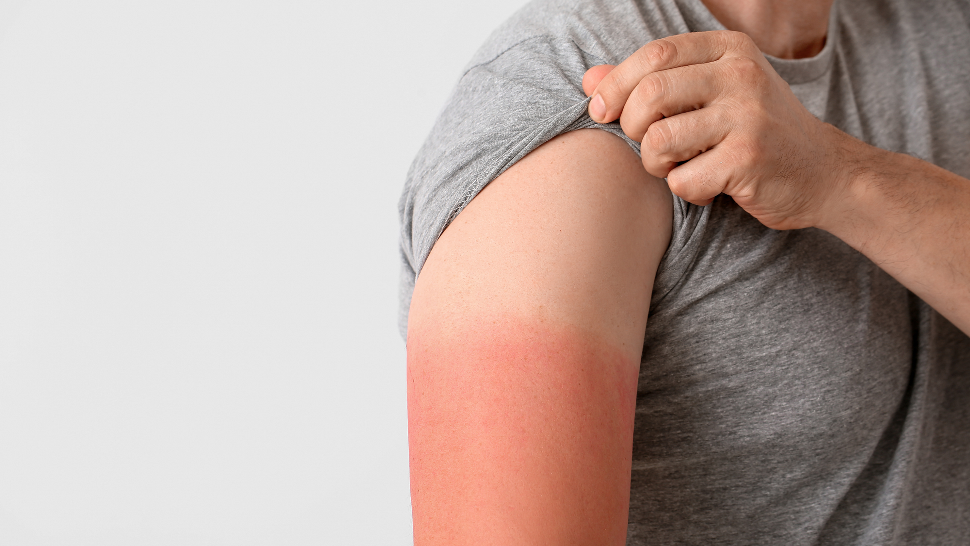 How many sunburns does it take to get skin cancer?