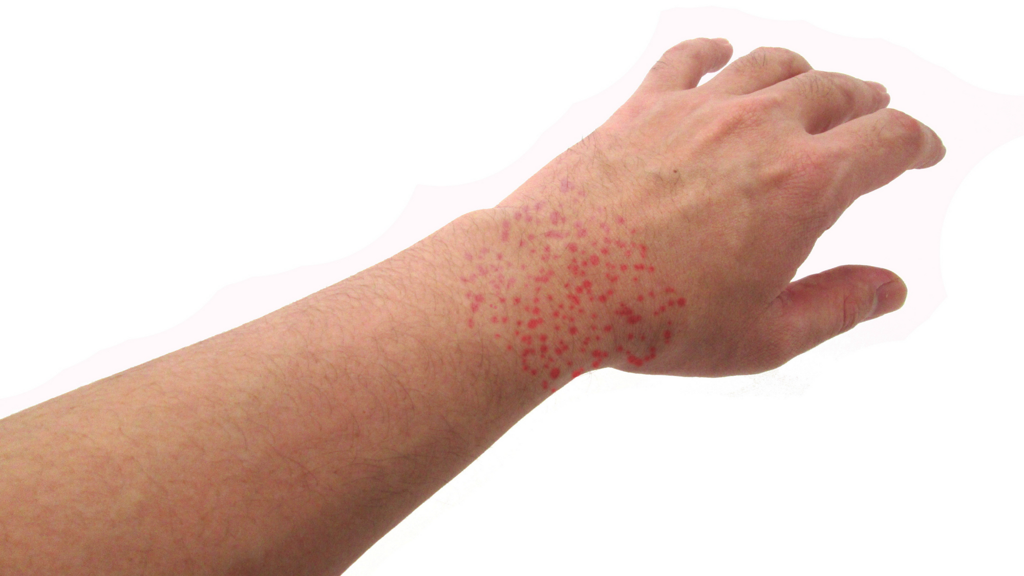 蕁麻疹の家庭療法