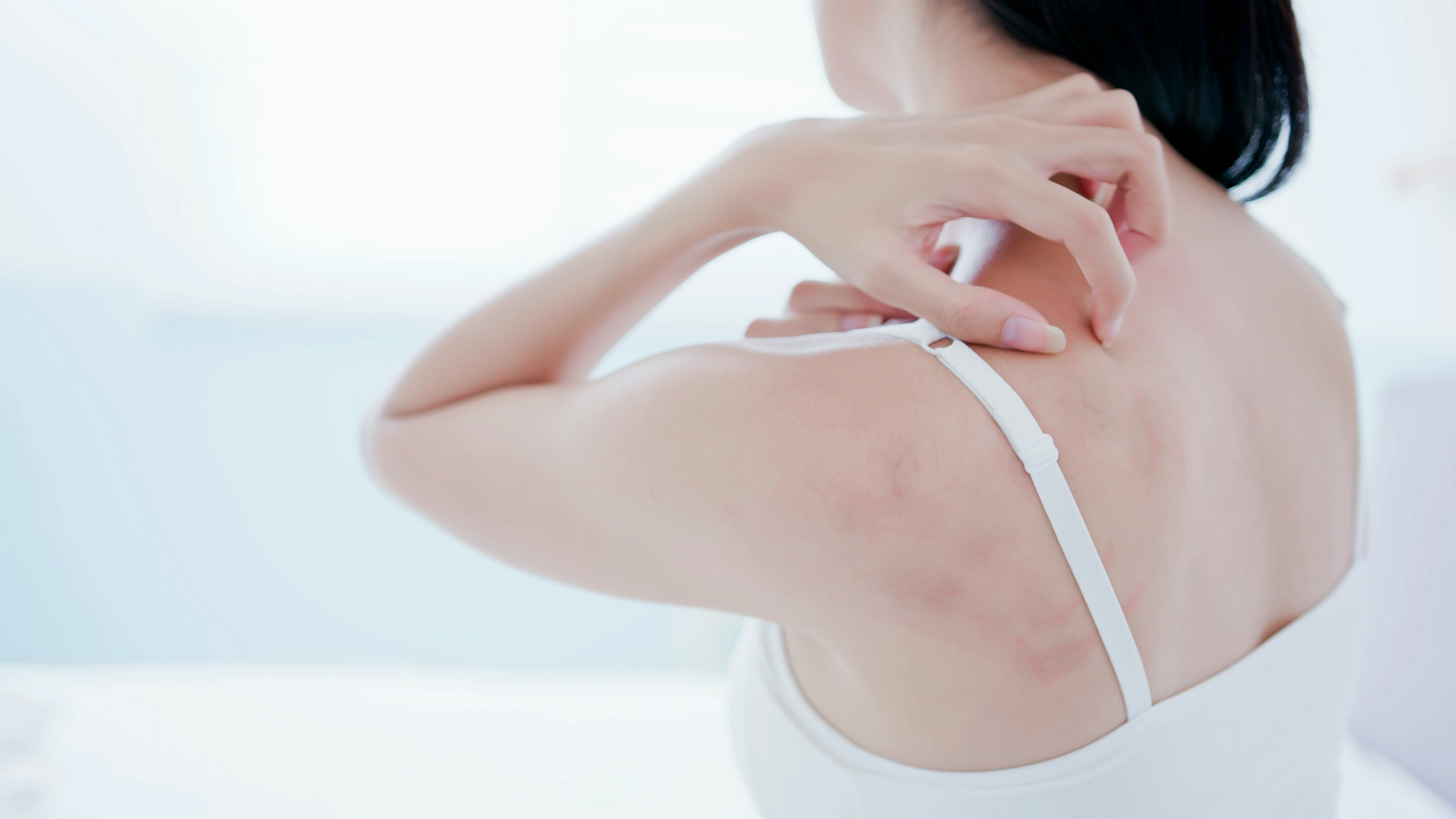 What are the different types of eczema?