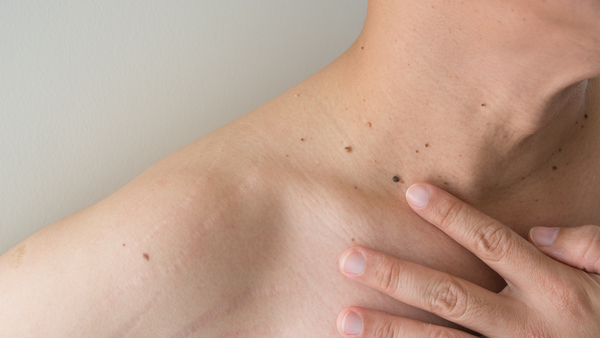 What’s the difference between a benign and a malignant mole?