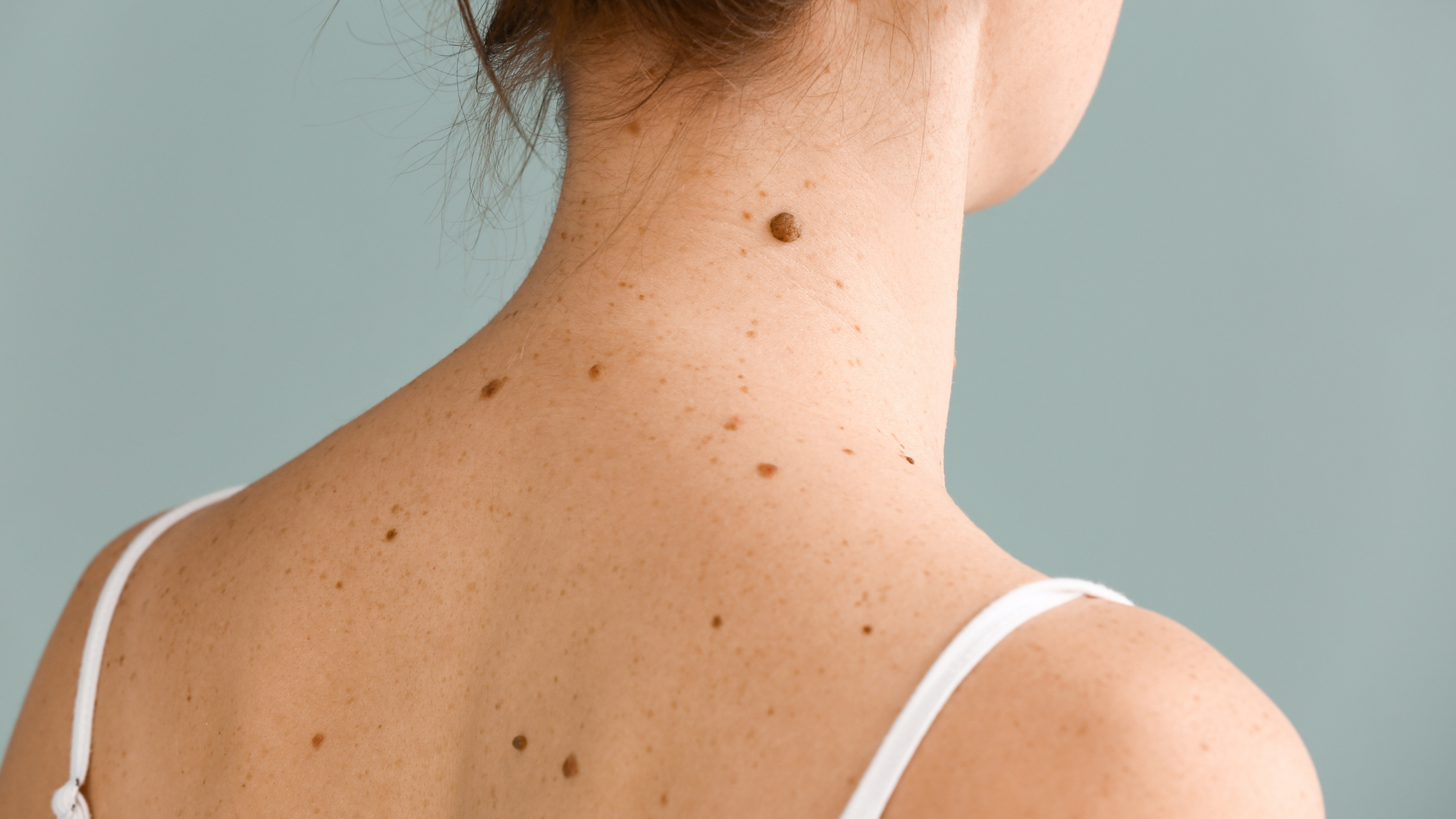 Why do I get moles on my skin?